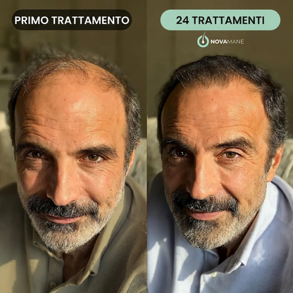 Capelli più folti in 5 minuti con il Sistema Micro-Infusione miCroFol